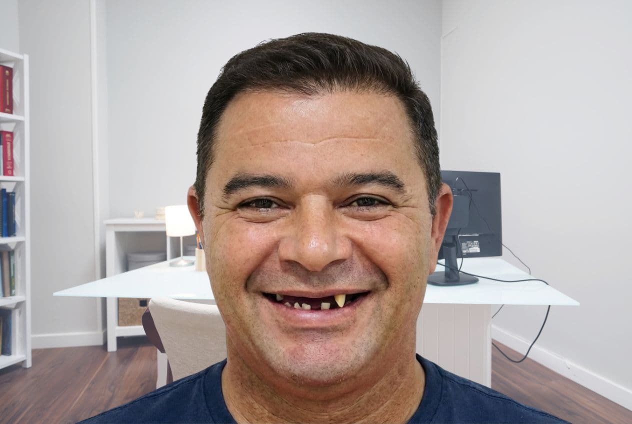 AI Smile Design — Before